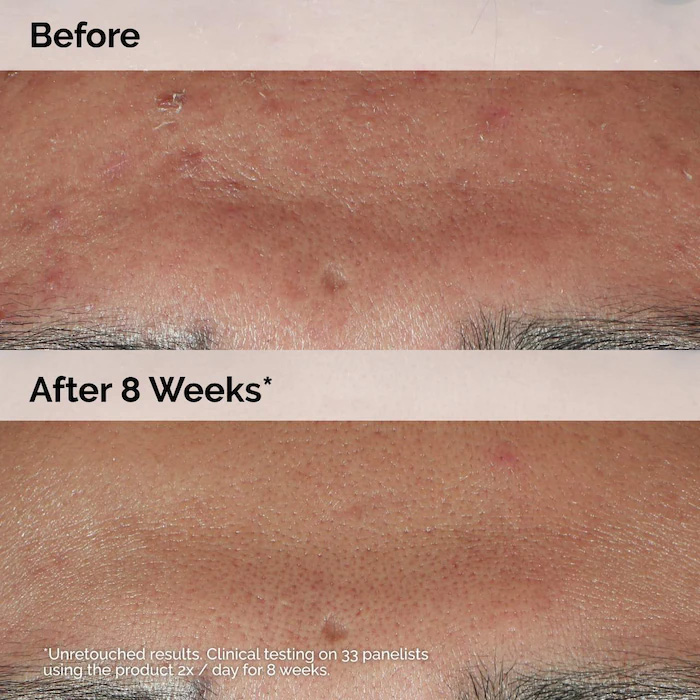 سرم ضد جوش Niacinamide 10% + Zinc 1% اوردینری حجم 60 میلی لیتر